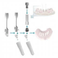 Composant Smart Overdenture...